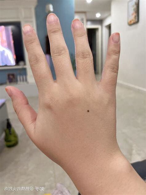 小指有痣 左手